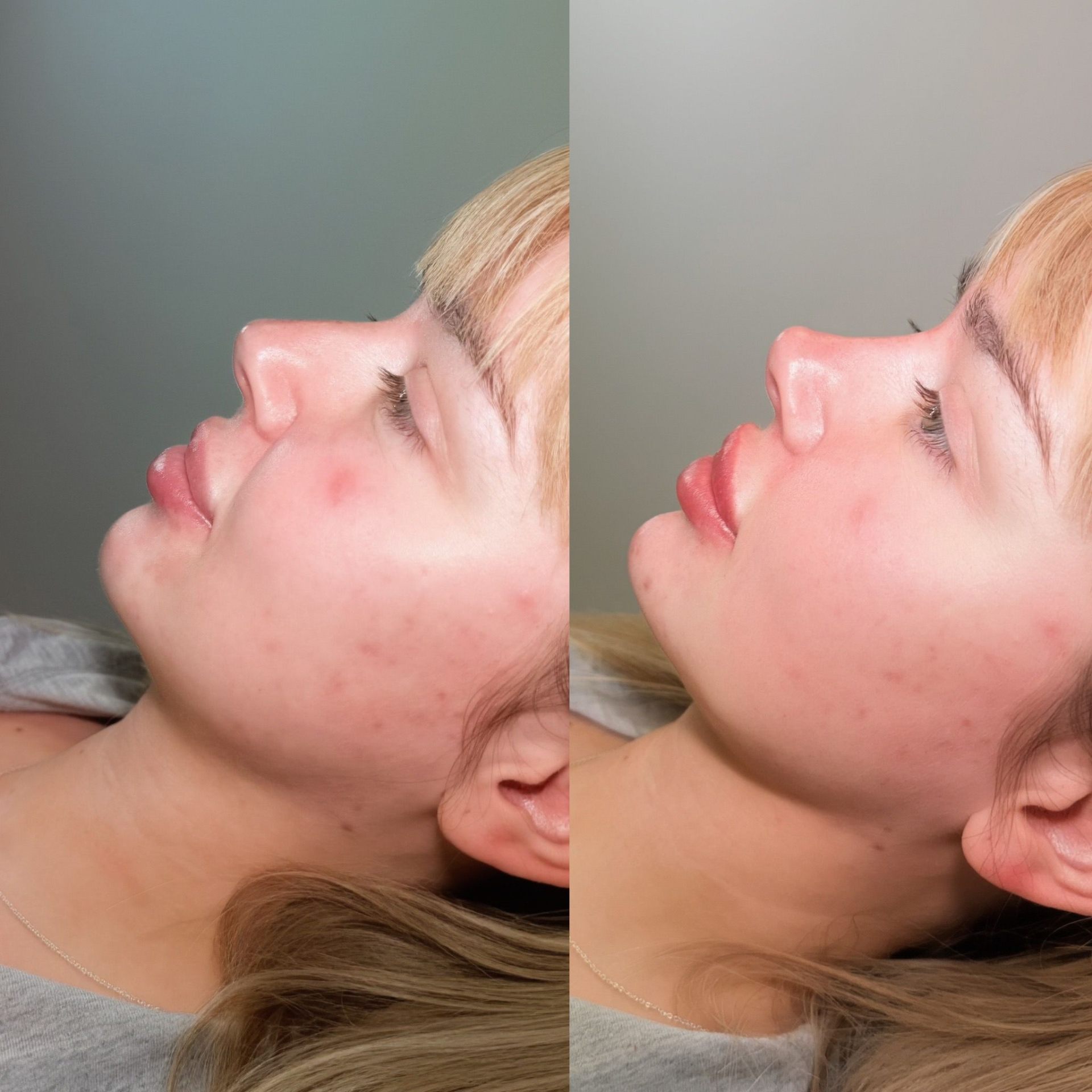 Lip enhancement